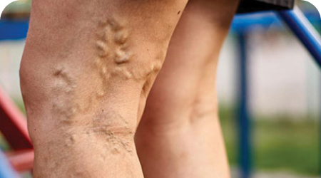 Varicose Veins