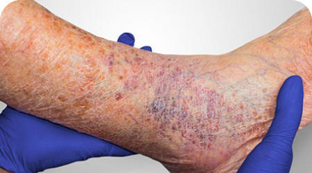 Leg Ulcers
