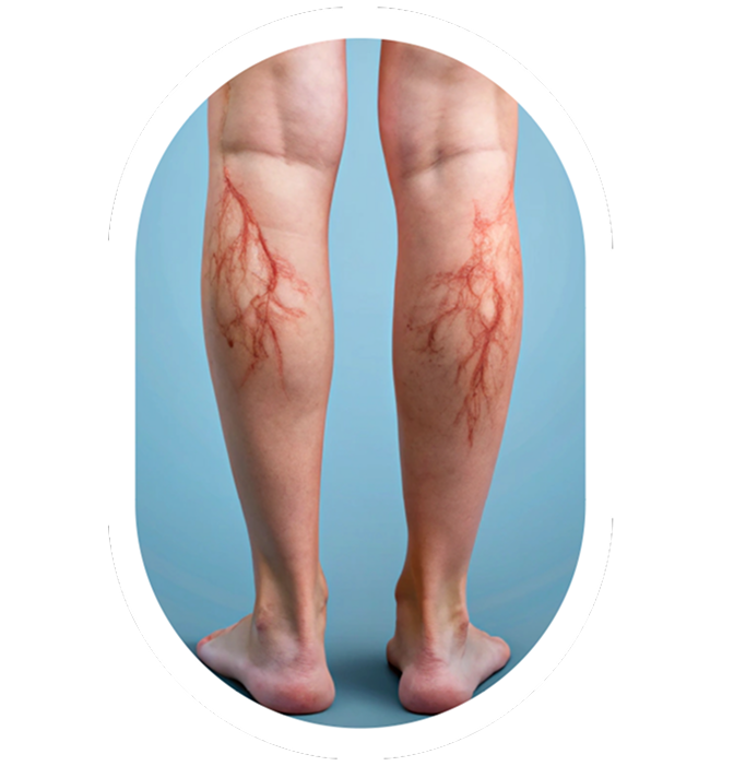 Varicose Veins Legs